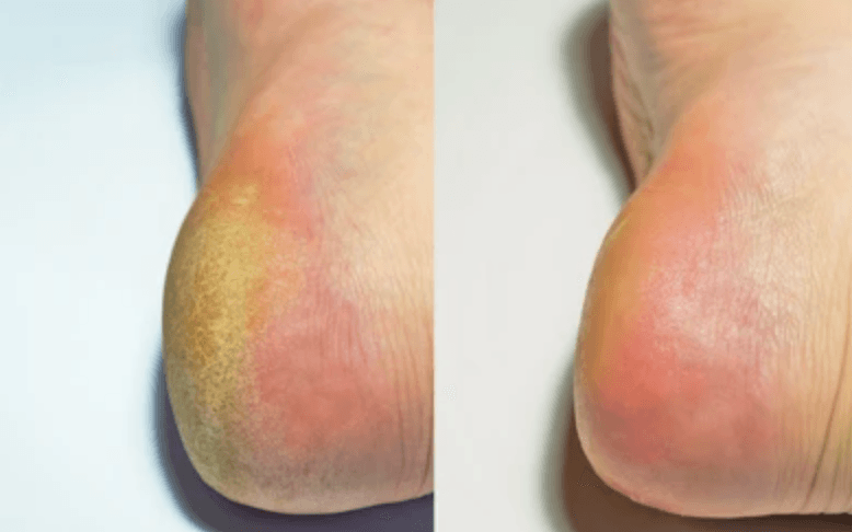 Before and after founder sole photos showing callus improvement