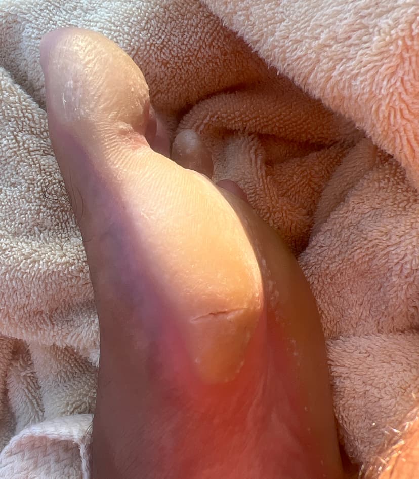 Close-up forefoot callus detail showing dense buildup that feels like a pebble underfoot