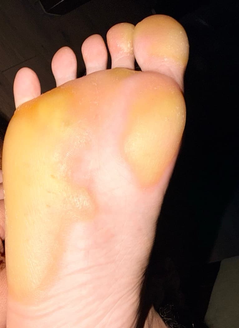 Founder full sole showing plantar callus buildup — proof this comes from lived experience