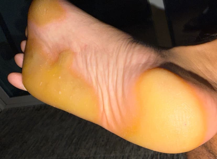 Founder pressure pattern showing heel and forefoot callus buildup zones